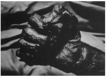 124 L. CAPASSO Figure 1. Detail of the right hand of the Val Senales mummy (Tyrol). The total absence of the nails (lost post mortem) and the good preservation of the nail bed are evident.