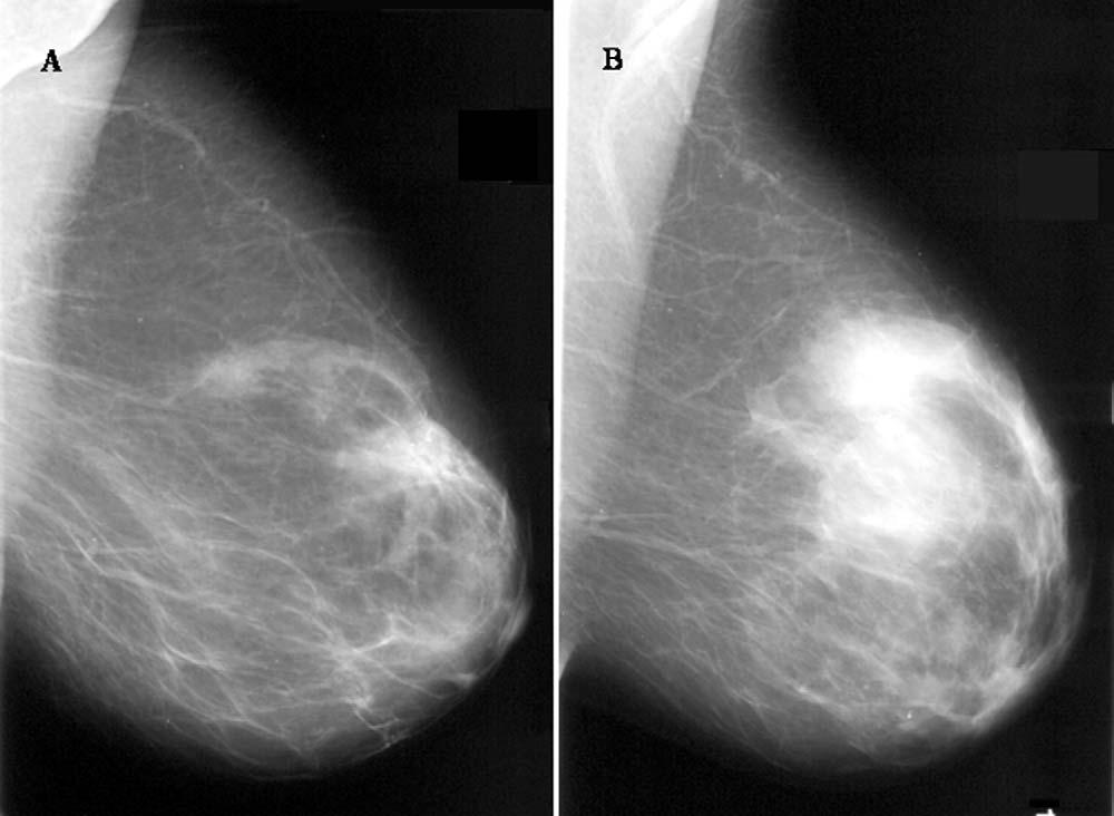 FIGURE 1 Change in mammographic breast density between baseline (A) and 18 months (B) in one woman during treatment with oral E 2 V (2 mg)/lng-ius (20 g/24 hours). Lundström.