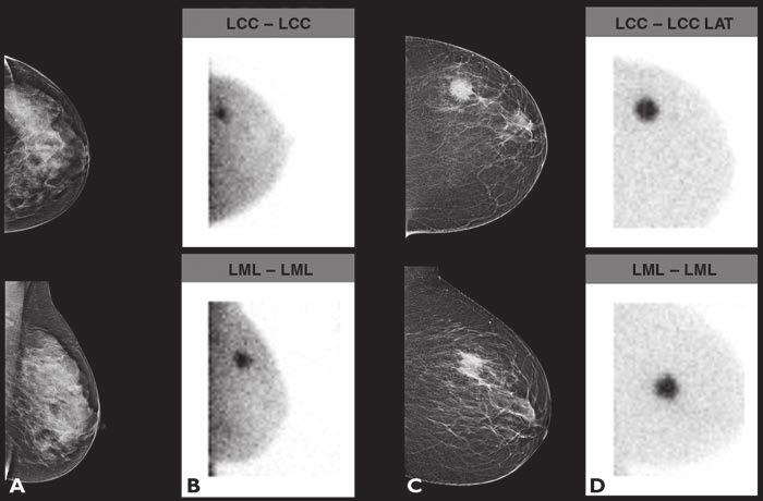BSGI in Dense Versus Nondense Breasts breast tissue. This study shows that the sensitivity of BSGI was similar in women with dense (94.7%) and nondense breasts (96.
