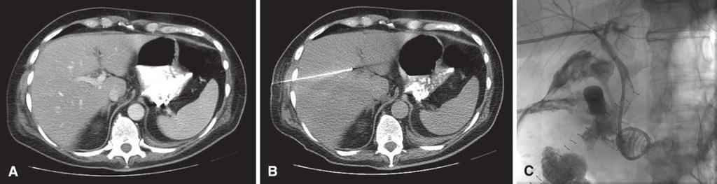 Kühn et al. Fig. 3 55-year-old woman who underwent complicated cholecystectomy, with bile duct leakage and perforated duodenal ulcer.