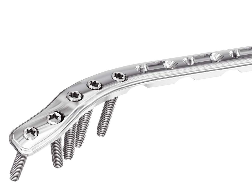 3.5 mm LCP Extra-articular Distal Humerus Plate Features Left and right plates are anatomically contoured to match the posterolateral distal humerus Locking screws engaged in the plate create a
