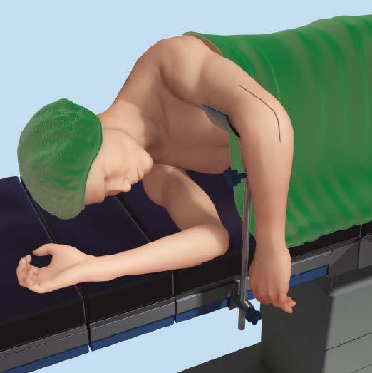 Approach 2 Position patient Positioning is by surgeon preference. However, the lateral decubitus position is frequently chosen. Rest the arm on a padded bar allowing elbow flexion of 120.