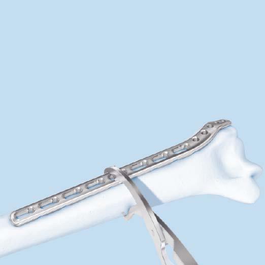 Reduce Fracture 1 Reduce fracture and fix temporarily Use pointed forceps for temporary fixation in restoring the anatomy. Ensure that forceps will not interfere with subsequent plate placement.