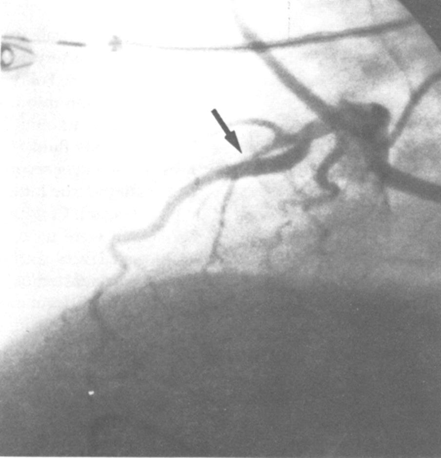 Total occlusion of the LD artery (arrow) occurred distal to the site of balloon inpation. t operation, a distal dissection of the LD artery was found. left ventricular function (Fig 4).