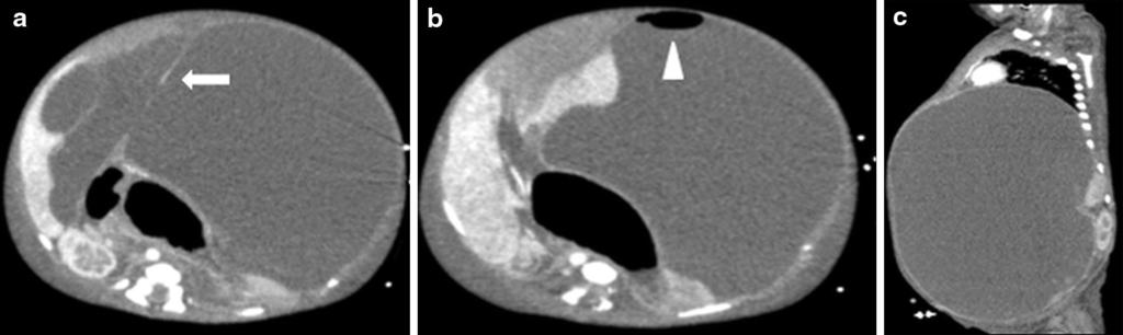 624 Jpn J Radiol (2014) 32:623 629 Fig. 1 Meconium pseudocyst in a newborn. a, b, c Axial and sagittal CT images show a giant cystic mass filling the abdomen and displacing the bowel loops laterally.
