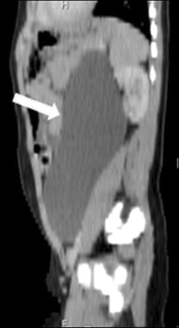 On CT, findings similar to those of US are detected; however, CT may be helpful in revealing wall calcification.