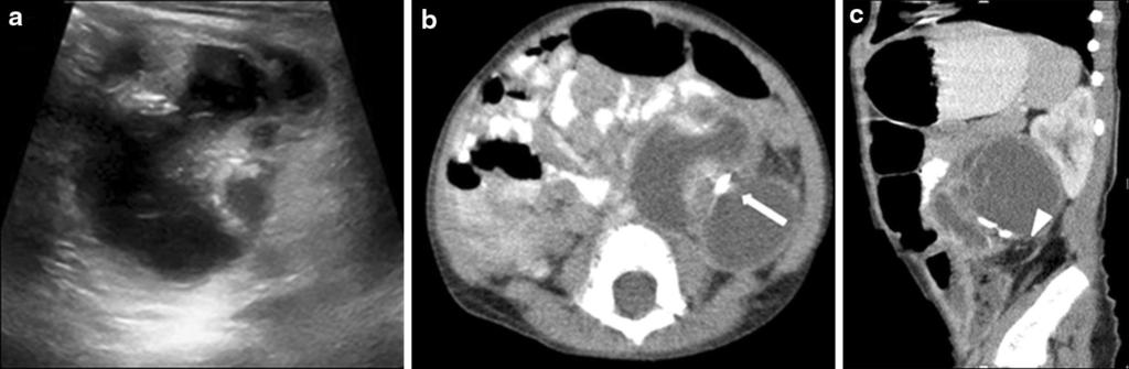 Jpn J Radiol (2014) 32:623 629 625 Fig. 3 Retroperitoneal teratoma in a 4-year-old girl. a US shows a heterogeneous cystic mass containing solid component.
