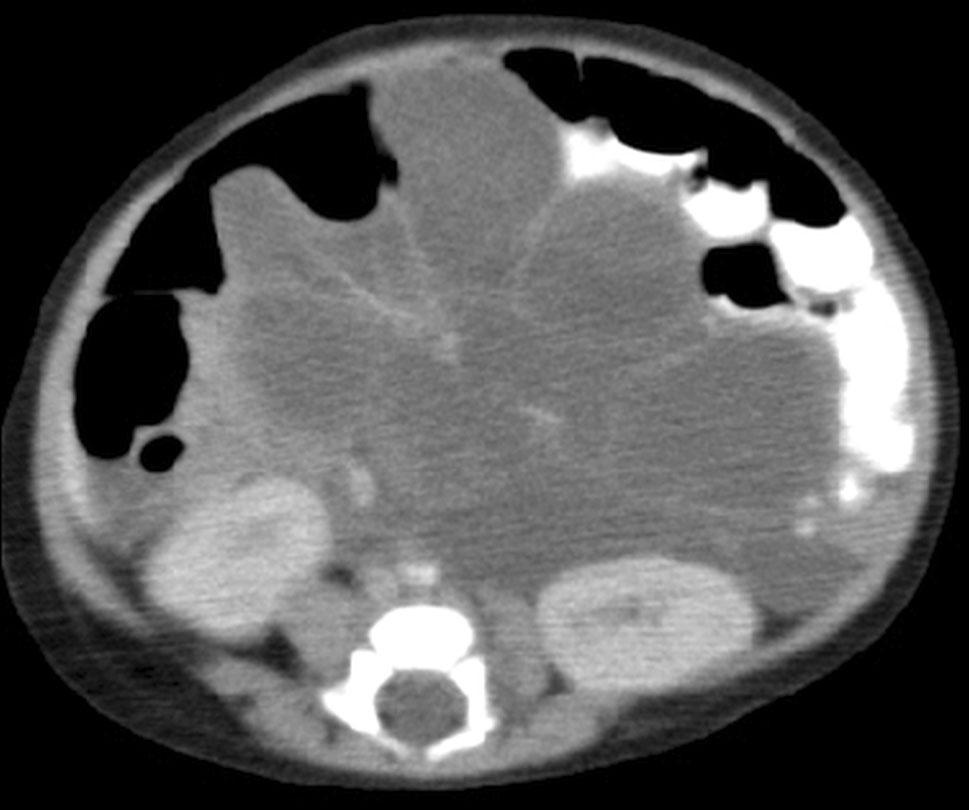 Abdominal lymphatic malformation is frequently seen in a mesenteric location, and is the most commonly encountered mesenteric cyst [1, 7].