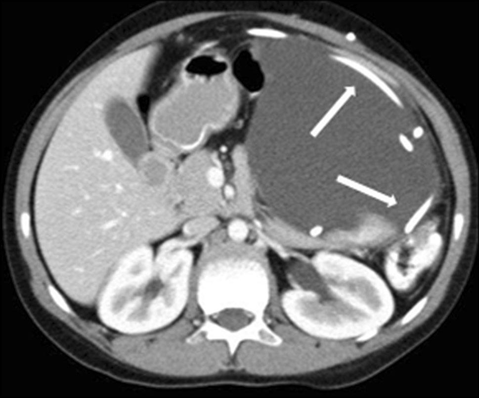 CT shows a cystic mass in the left part of the abdomen; the ventriculoperitoneal shunt catheter is within the cyst (arrows) ileum is the most common site.
