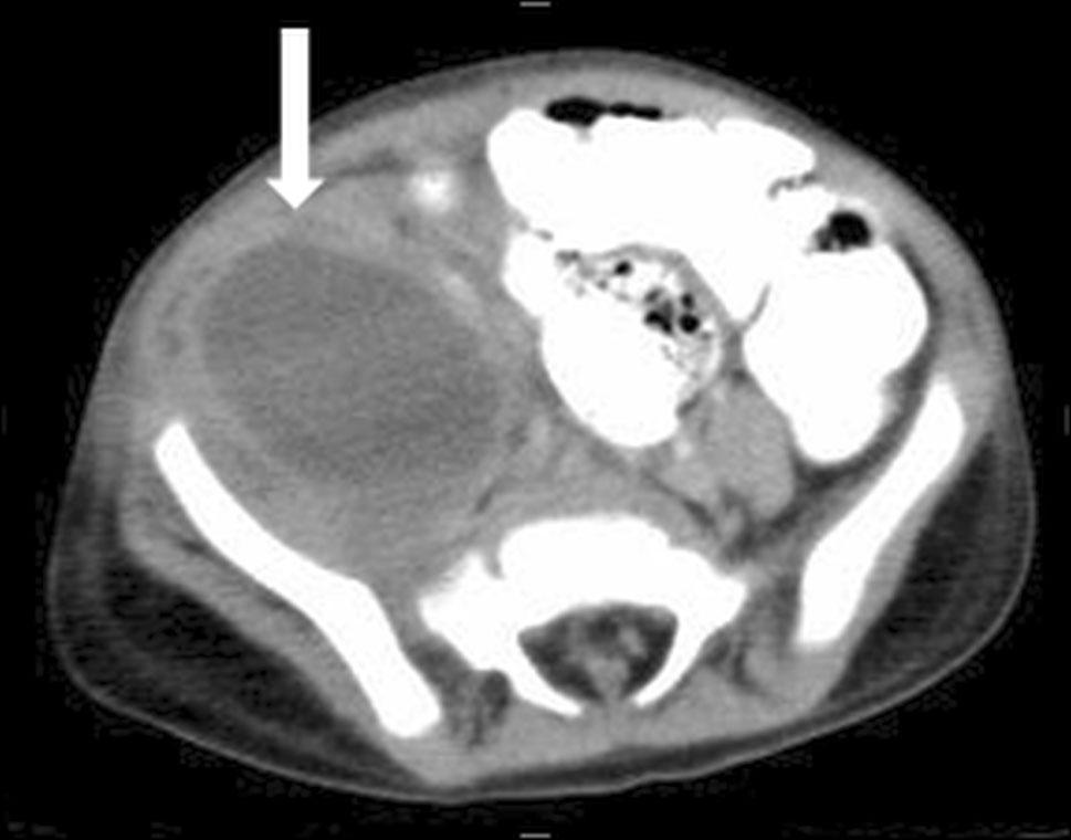 Axial CT shows a hypodense cystic lesion in the right side of the pelvis (arrow).