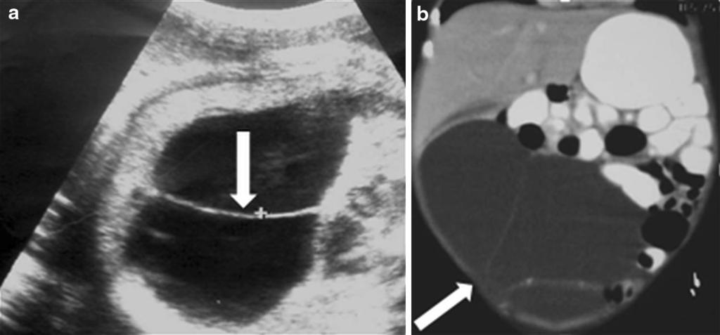 628 Jpn J Radiol (2014) 32:623 629 Fig. 11 Mesencymal hamartoma in a male newborn. a US shows a huge cystic mass with internal septations (arrow).