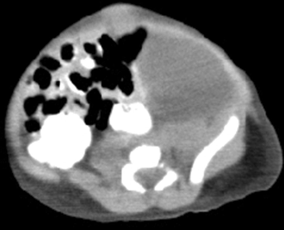 Note the lack of demonstrable continuity between the mass and the liver. Radiological prediagnosis was omental or mesenteric cyst. However, a pedunculated liver mass was found during surgery.