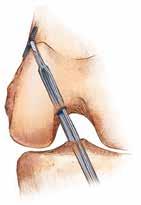 draw the graft through the tibial tunnel and into the femoral tunnel.