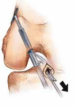 position the soft-tissue graft in the femoral tunnel (Figure 10).