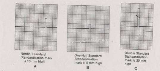 Electrocardiograph Paper Horizontal Axis: 1 small square = 0.04 seconds 5 small squares = 0.2 seconds 5 large squares = 1 second Vertical Axis: 1 small square = 0.1 mv 5 small squares = 0.