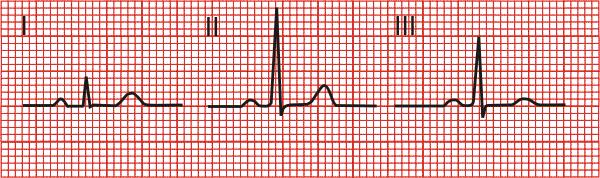 htm Standard and Augmented Leads Standard Leads I, II, and III Usually tracings are read in Lead II P waves