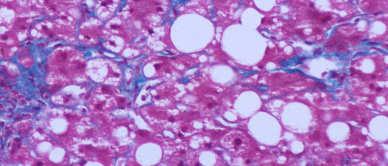 steatosis Metabolic Syndrome Fatty Liver Disease INSULIN RESISTANCE M > F Hepatocytes, macrophages