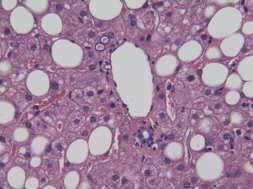 02) 67% had histologic response; decreased steatosis, ballooning, lobular inflammation, Mallory s hyaline, fibrosis (p<.05) No change in portal inflammation. Steatosis decreased in all (p <.