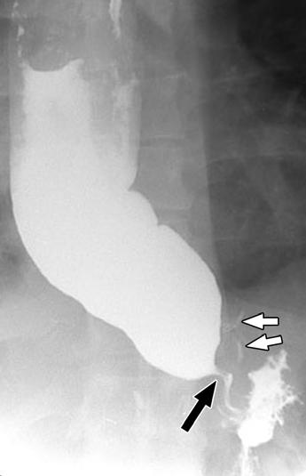 Fig. 1 45-year-old man with secondary achalasia after laparoscopic Nissen fundoplication.