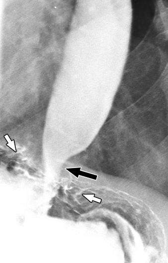 junction and delayed emptying of barium into stomach. There was no evidence of primary peristalsis at fluoroscopy.