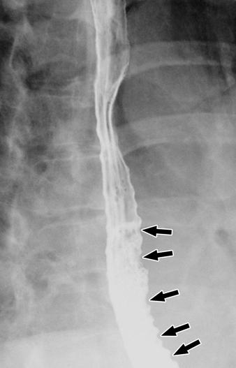 When the patients were stratified on the basis of the type of esophageal dysmotility, two patients with secondary achalasia had dysphagia and one had intractable hiccups and regurgitation.
