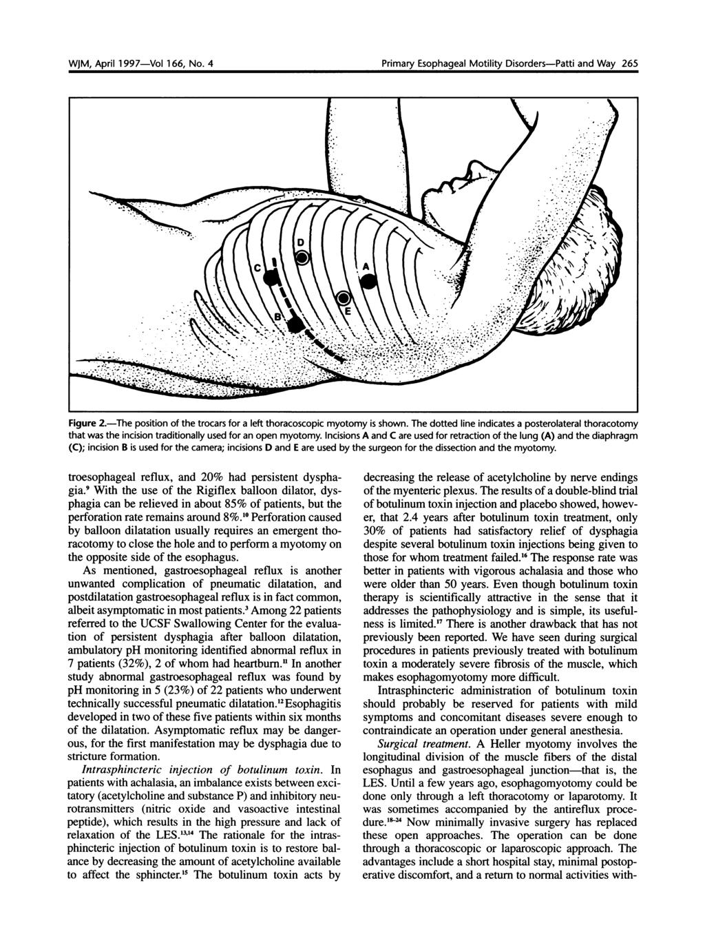 WJM, April 1997-Vol 166, No. 4 Primary Esophageal Motility Disorders-Patti and Way 265 WJM,~~ 97Vl16 Api Figure 2.-The position of the trocars for a left thoracoscopic myotomy is shown.