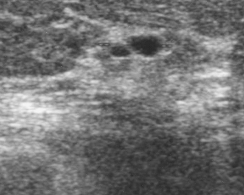 Mammography and Sonography of Breast Tumors Fig. 1. 52-year-old woman with mucocele-like tumor of breast.