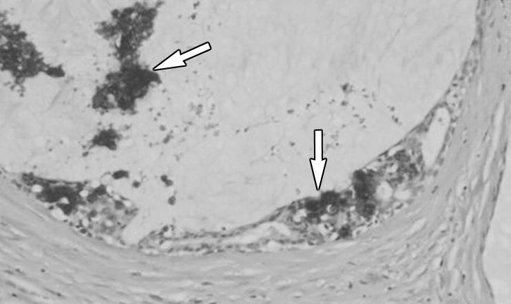 Glazebrook and Reynolds evaluated for atypia or malignancy if calcifications are present and if a mucocele-like tumor is histologically identified, especially at core needle biopsy.
