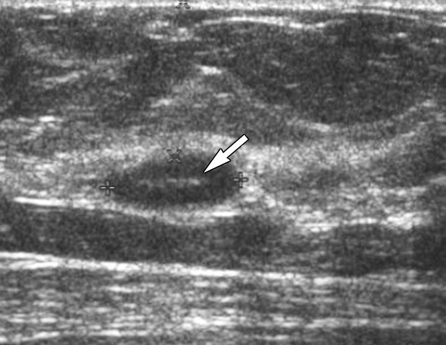 Mammography and Sonography of Breast Tumors Fig. 4. 48-year-old woman with mucocele-like tumor of breast. Sonogram shows well-defined mass originally identified on screening mammography.