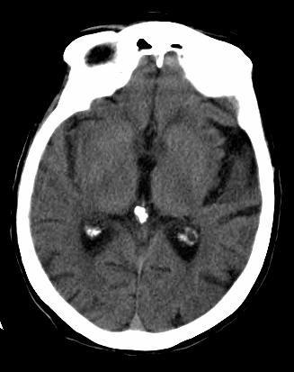 CT Imaging in Acute Stroke - 2 HOWEVER, CT is poor at detecting acute infarcts Only 40% sensitivity <24 h Our Patient