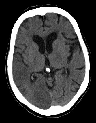 Our patient BF: CT#2 8 hours later As time passes, classic signs of stroke appear: Loss of gray-white