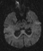 DWI in BF at 2 hours post-stroke In our patient, DWI sequences were performed during her initial MRI A faint increase in DWI signal was observed in the