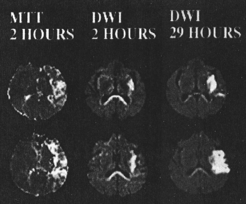 Correlation of Perfusion Imaging with Infarct Progression MTT = area of low/ slow blood flow DWI Early (2h): =small area of injury = area at risk for