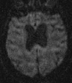 Progression of Infarct in BF: DWI at 30 hrs post-stroke normal DWI normal