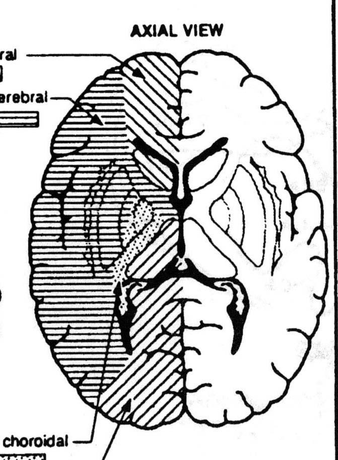 Summary Extent of infarct our patient R. MCA territory R.