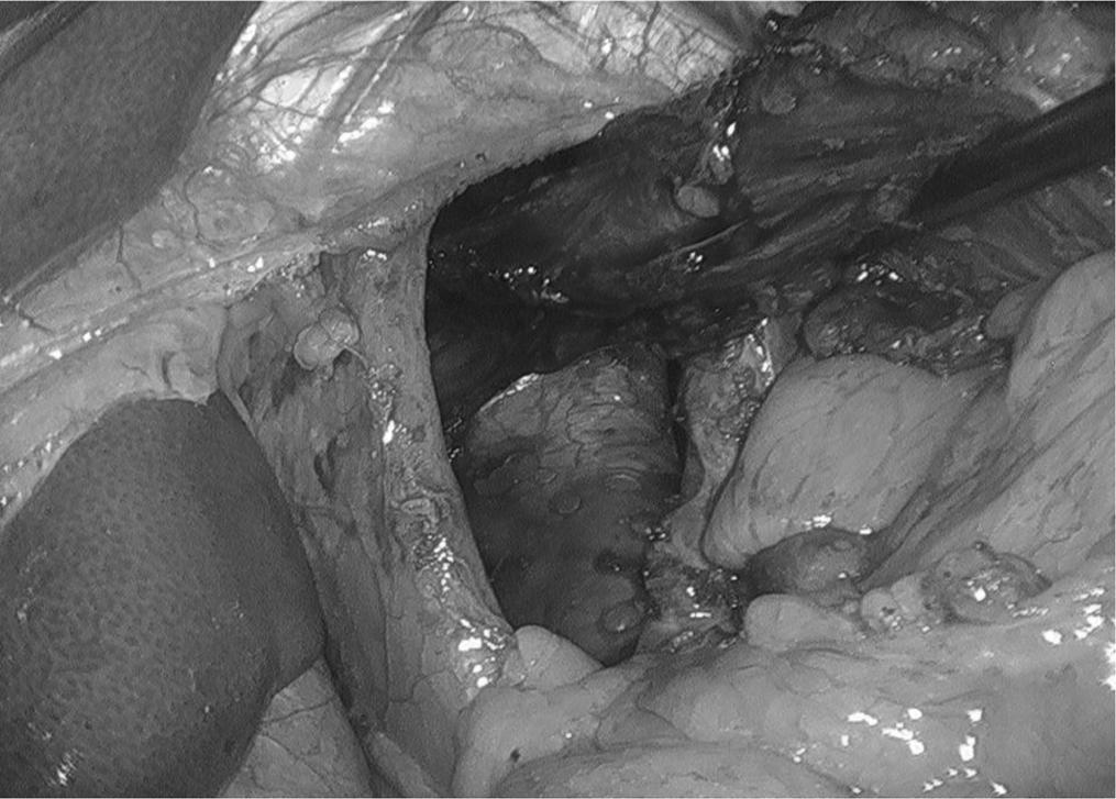 Laparoscopic Paraesophageal Hernia Repair with Acellular Dermal Matrix Cruroplasty, Diaz DF et al. collagen matrix that is remodeled when utilized in hernia repair to allow for a stronger repair.