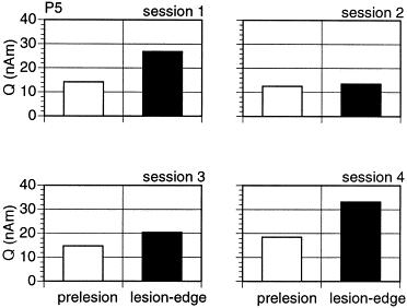 Fig.4 Estimated cortical strength for patient P5, calculated from measurements carried out 11 (session 1), 12 (session 2), 12.5 (session 3) and 13 (session 4) months after lesion onset (hearing loss).