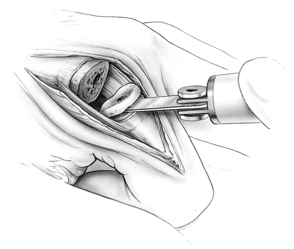 6.7 Phalangeal Osteotomy The phalangeal base osteotomy is made in two steps: FIGURE 6.7.1 Step 1: Step 2: A guided partial osteotomy is made using the distal osteotomy guide mounted on the alignment awl.
