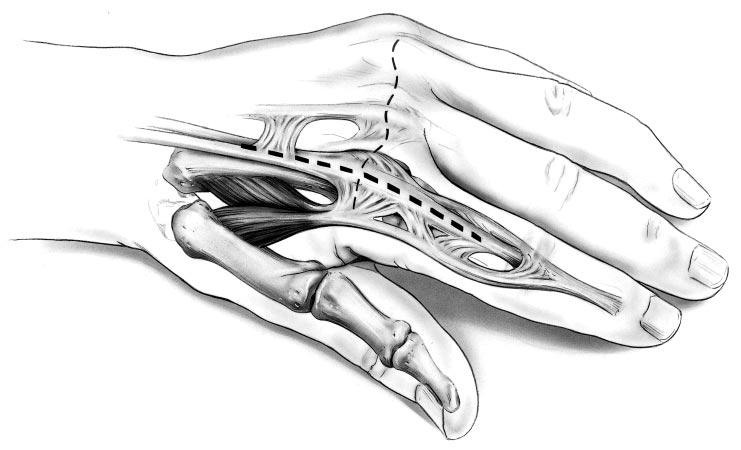 6.0 Surgical Technique 6.1 Initial Incision and Joint Exposure For single joint involvement: A longitudinal incision is made over the dorsum of the metacarpophalangeal (MCP) joint (FIGURE 6.1.1).