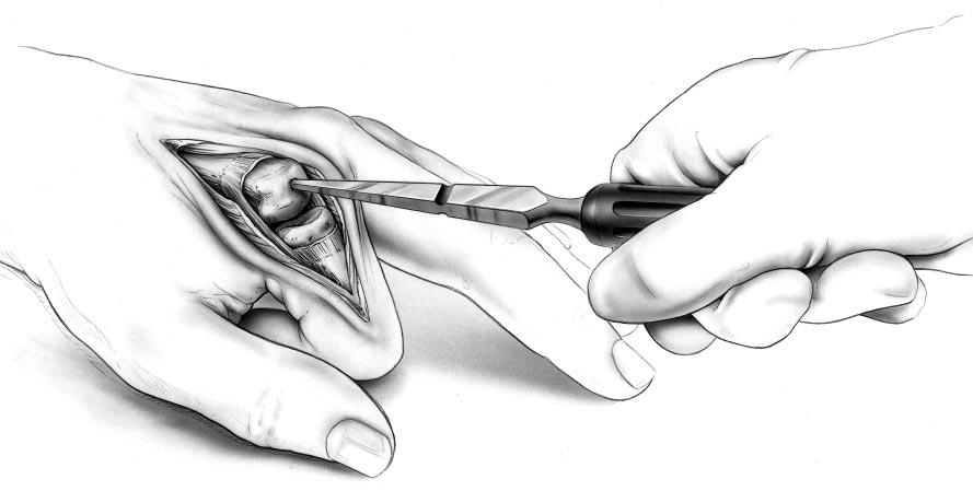 1 For multiple joint involvement: A curving transverse incision across the dorsum of the MCPs is recommended when multiple joints are involved (FIGURE 6.1.1).