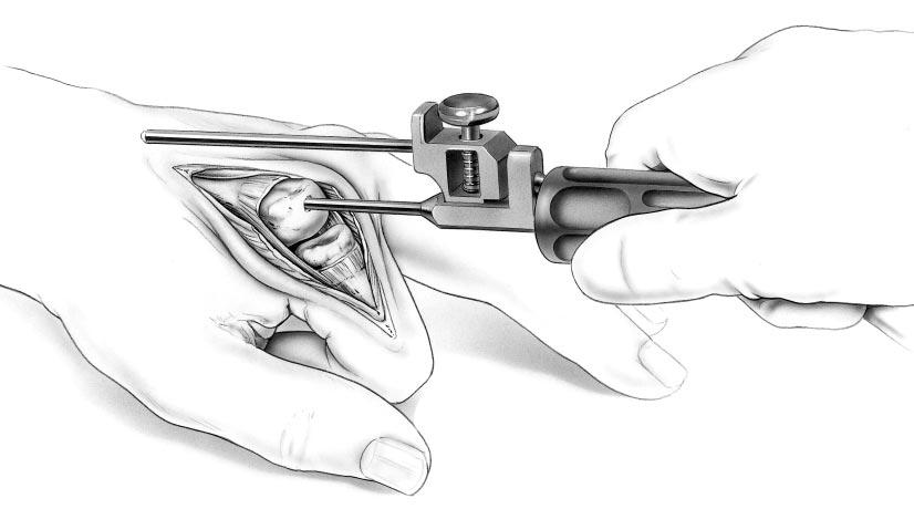 6.3 Establishing Metacarpal Medullary Canal Alignment Attach the alignment guide to the alignment awl, (FIGURE 4.2) insert the alignment awl into the puncture (FIGURE 6.3.1) and advance it into the medullary canal one-half to two-thirds the length of the metacarpal (FIGURE 6.