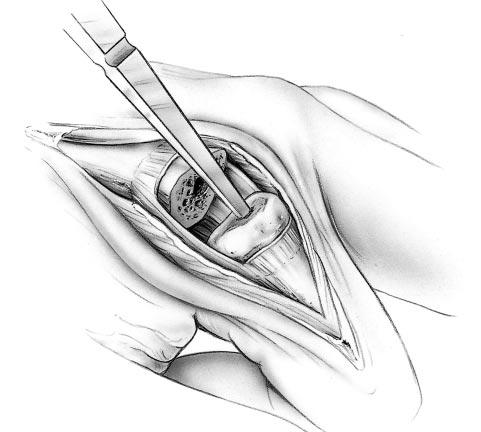 6.5 Opening the Phalangeal Medullary Canal FIGURE 6.5.1 With the joint flexed, the starter awl is used to make the initial puncture of the proximal phalangeal base (FIGURE 6.5.1).