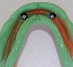 Take a reline impression using the existing overdenture as a tray. The black processing males will engage the LOCATOR abutments and hold the prosthesis in place while the impression material sets.