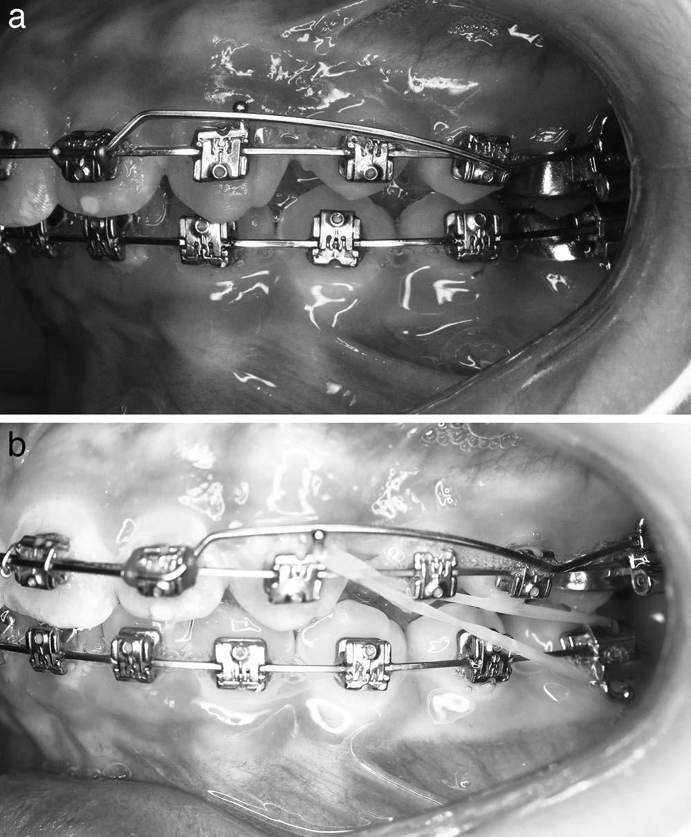 34 JANAKIRAMAN, GILL, UPADHYAY, NANDA, URIBE molar tip-back while the main arch wire uprighted the root. In addition, Class II elastics were used to retract the upper anterior teeth (Figure 2b).