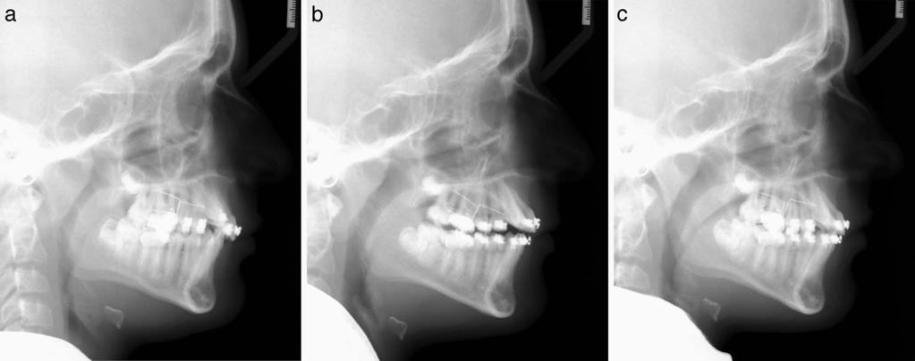 Lateral Cephalometric Analysis Figure 2. (a) Intraoral photographs at that start of study intervention (T1). (b) Photographs after completion of molar tip-back (T2).