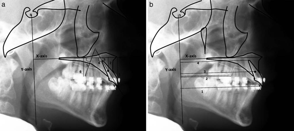 EVALUATION OF MOLAR CHANGES WITH TIP-BACK MECHANICS 35 Figure 4. (a, b) Measurements on regional superimposition of maxilla. X: Horizontal reference line passing from ANS to PNS.