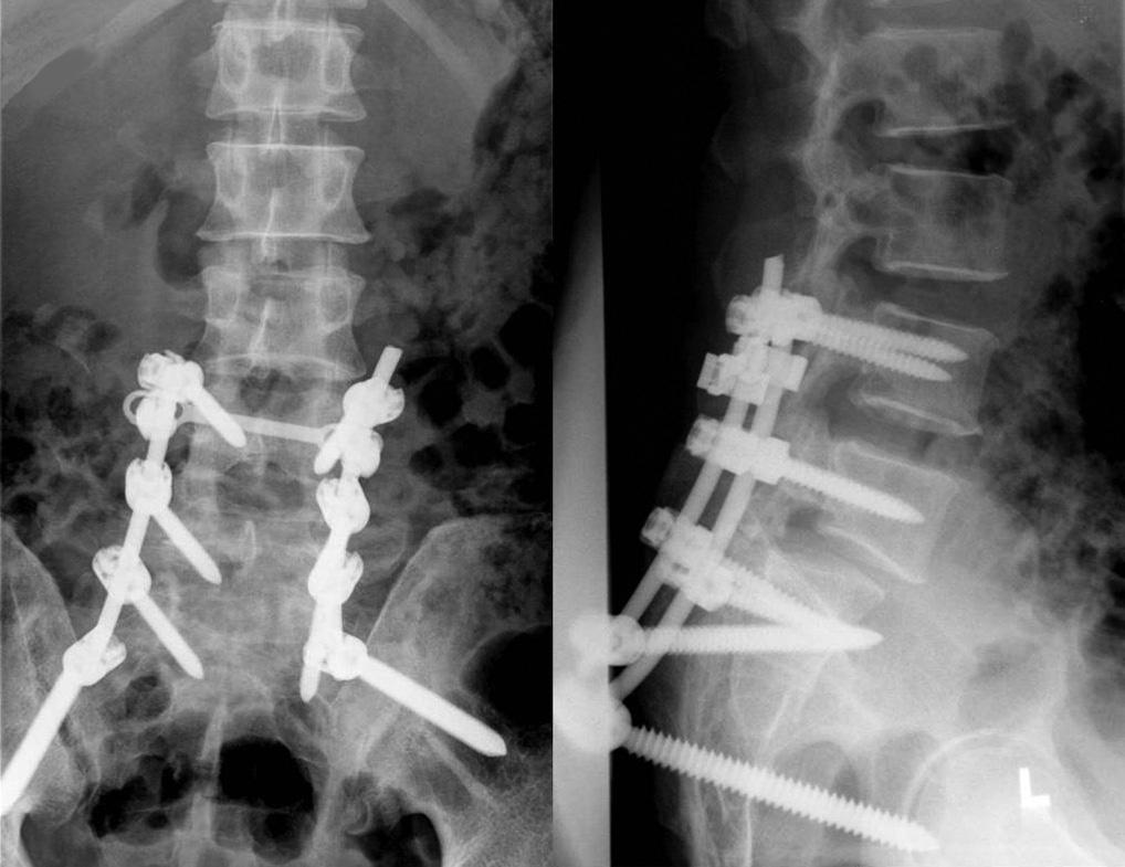362 CT Lim et al. Journal of Orthopaedic Surgery his pelvis was unstable.