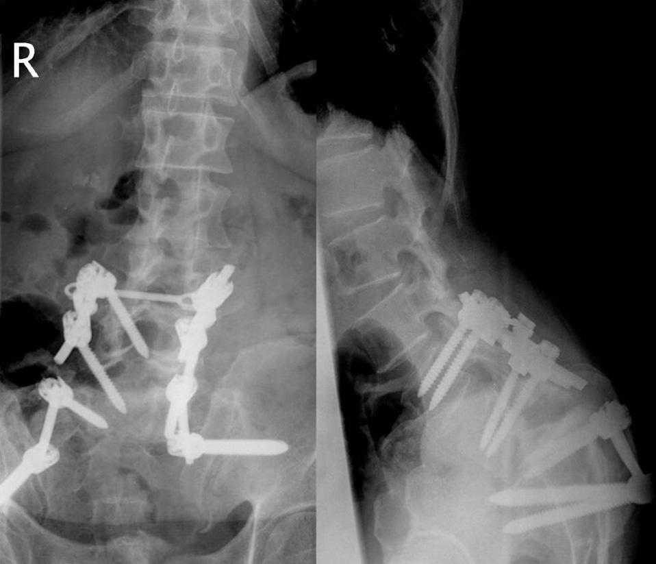 Plain radiographs showed anterolisthesis of L5 on S1 and an open-book pelvic fracture (Fig. 1a).