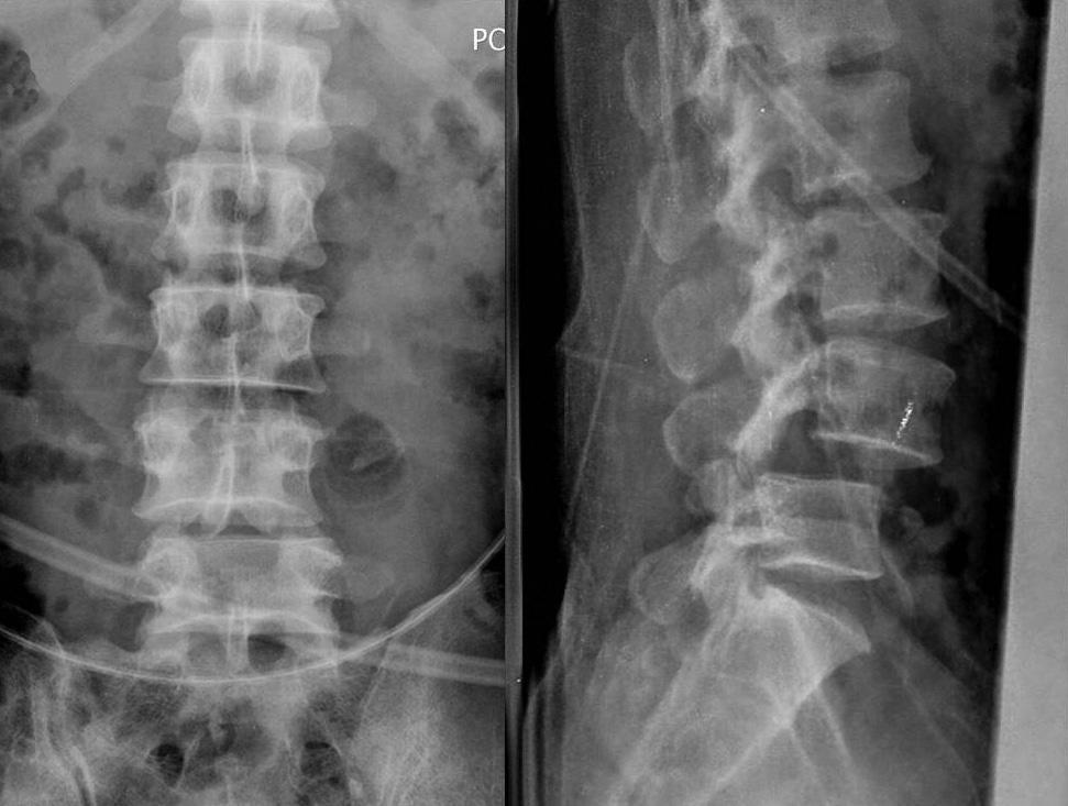 He was lost to further follow-up but returned 3 years postoperatively with low back pain radiating to his left lateral leg. The rods were found to be broken (Fig.