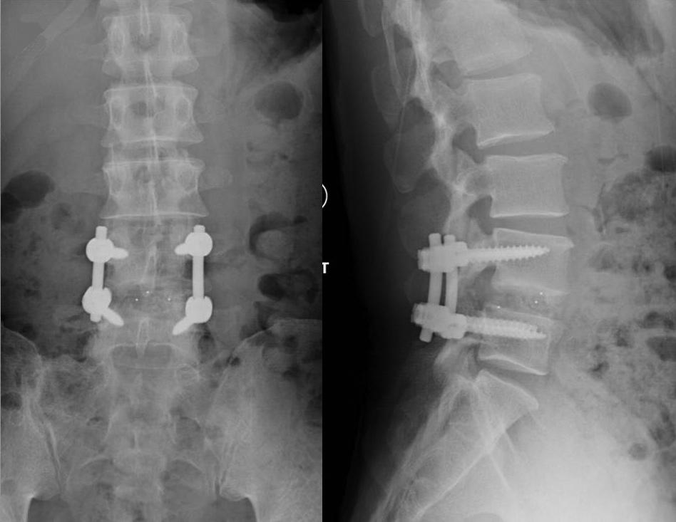At the 42-month follow-up, he was well with no neurological deficit. Case 2 In November 2007, a 41-year-old Chinese man presented with severe low back pain after a 600-kg container fell onto his back.